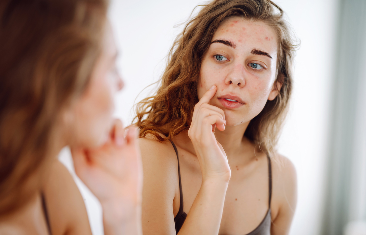Truths and Myths about Adult Acne