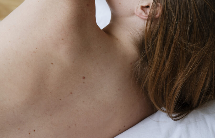 The importance of mole mapping for cancer