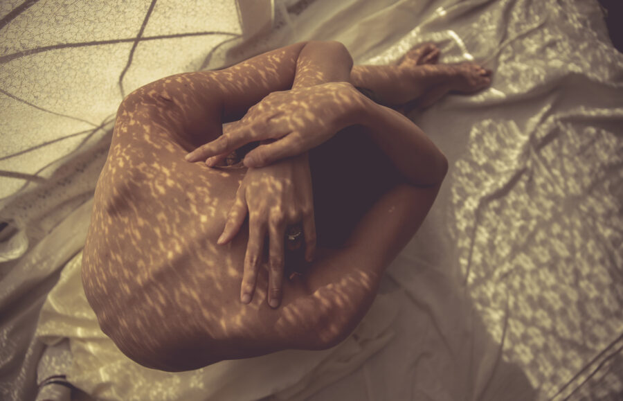 Vitiligo: New developments in therapeutic management